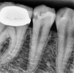 XDR Caries Enhanced