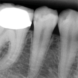 XDR Caries Original