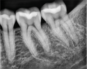 XDR Endo Enhanced
