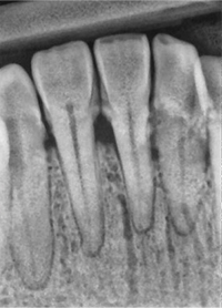 XDR Perio Enhanced