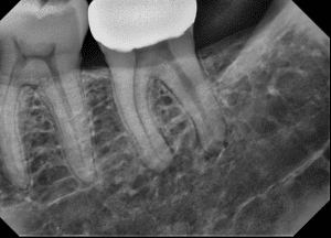 Figure 2b - Periapical Lesion, with Caries/Endo Filter