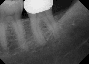 Figure 2a - Periapical Lesion, Unfiltered