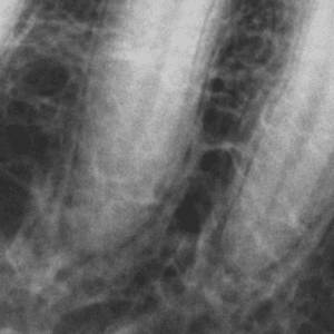 Figure 2b - Close Up of Periapical Lesion, Unfiltered