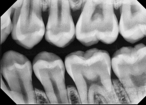 Figure 1b - Class II Lesion, with Caries/Endo Filter